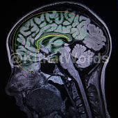 Epilepsy Image
