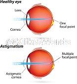 astigmatism Image