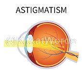 astigmatism Image