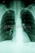 lung Image